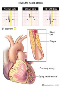 22233 nstemi heart attack illustration