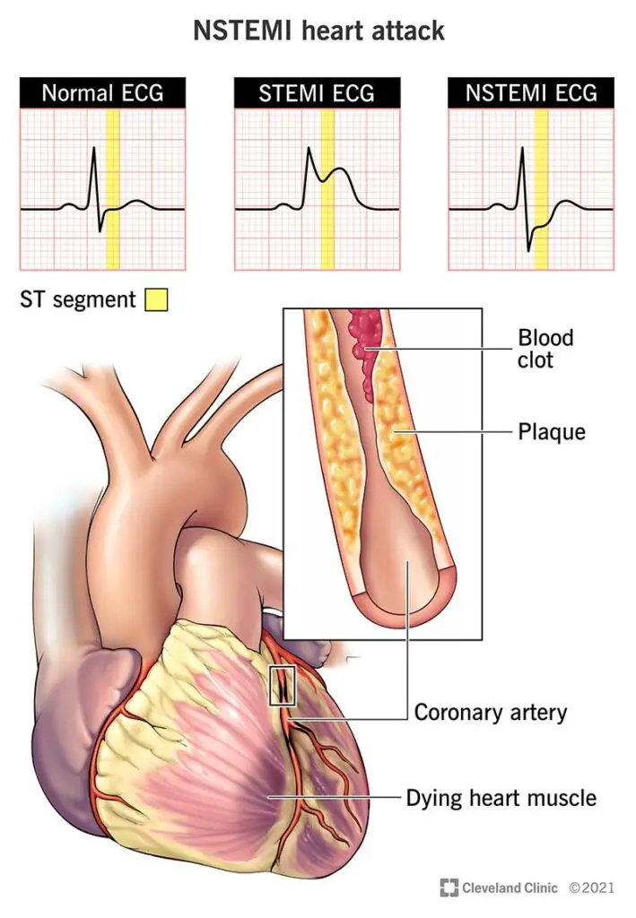 22233 nstemi heart attack illustration