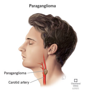 22394 paraganglioma