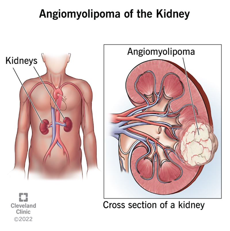 Inkstų angiomiolipoma: priežastys, simptomai ir gydymas 2 22415 angiomyolipoma kidney