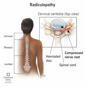 22564 radiculopathy