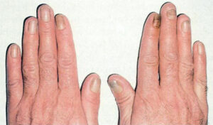 23009 yellow nail syndrome