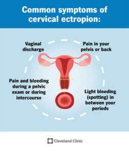 23053 cervical ectropion