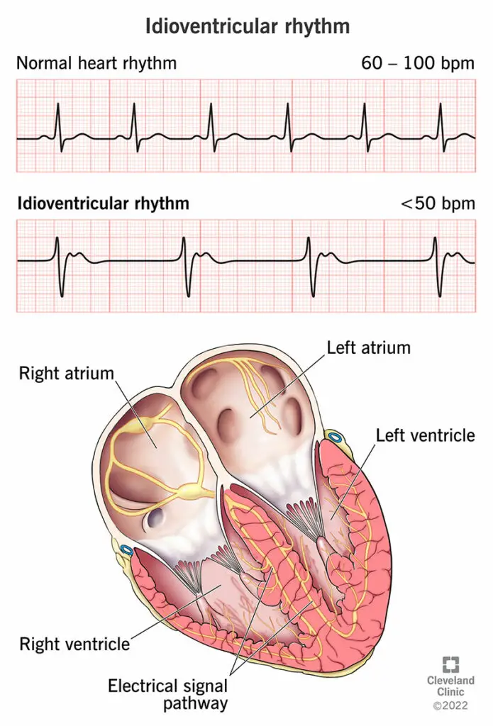 23070 idioventricular rhythm