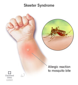 23289 skeeter syndrome