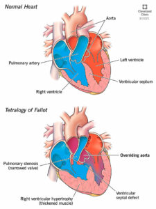 23347 overriding aorta