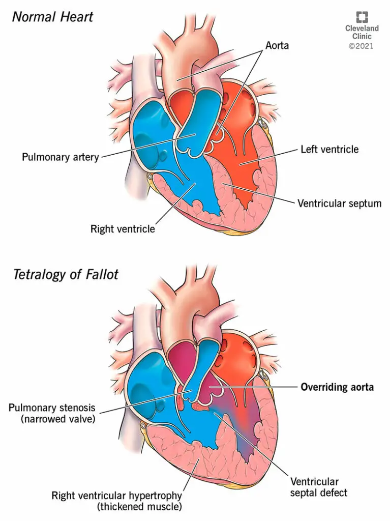 23347 overriding aorta