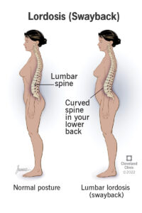 23908 lordosis