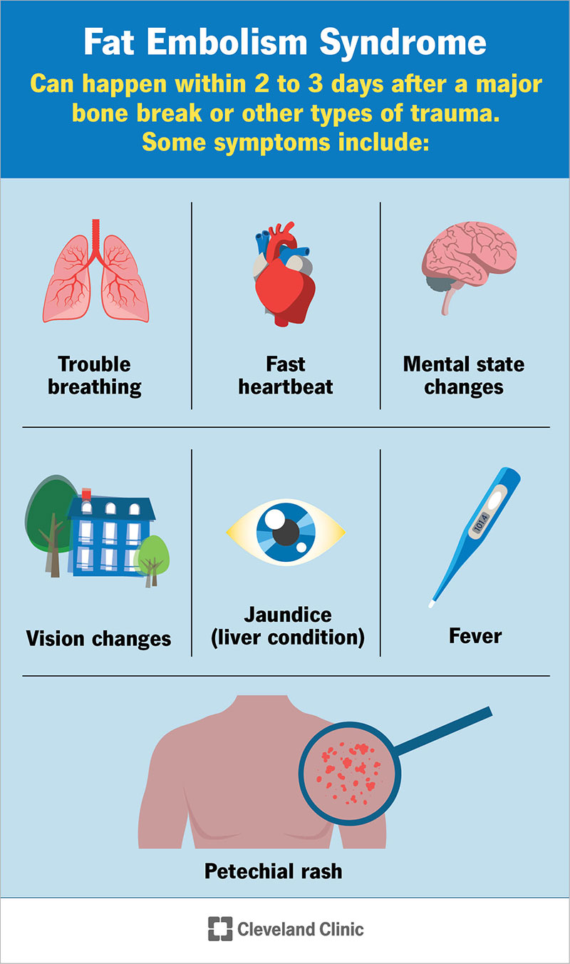 Riebalų embolijos sindromo simptomai gali būti kvėpavimo sutrikimai, karščiavimas, regėjimo pokyčiai ir greitas širdies plakimas.