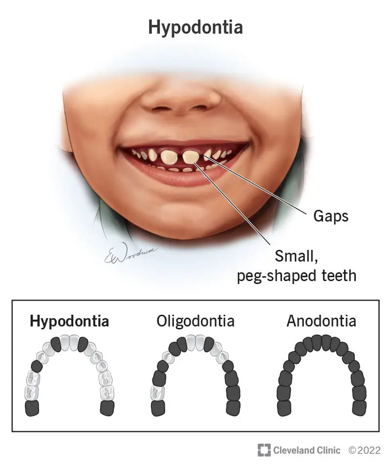 24192 hypodontia