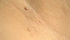 24330 vaginal skin tag 1184725929