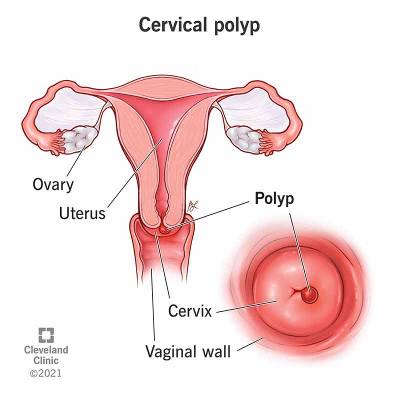 24436 cervical polyp