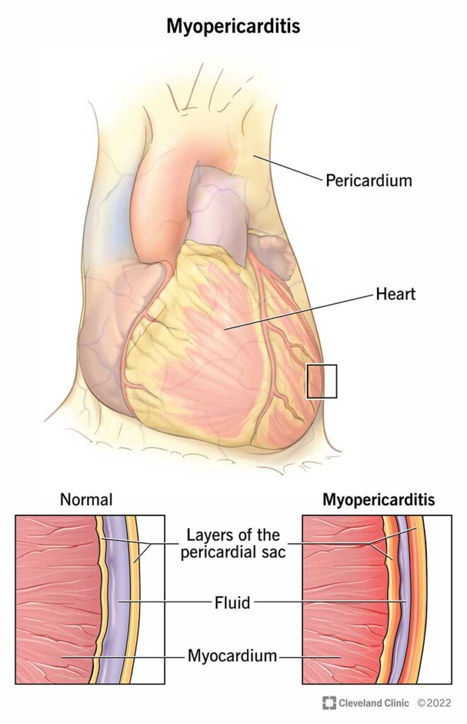 24579 myopericarditis