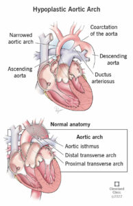 24920 hypoplastic aortic arch