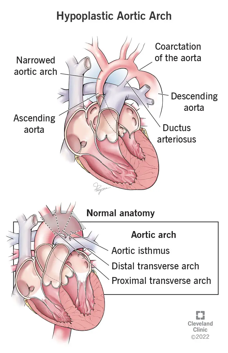 Aortos koarktacija su aortos lanko hipoplazija ir normalia aortos lanko anatomija.