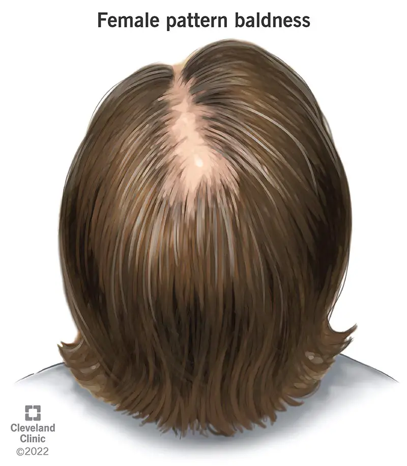 24943 female pattern baldness