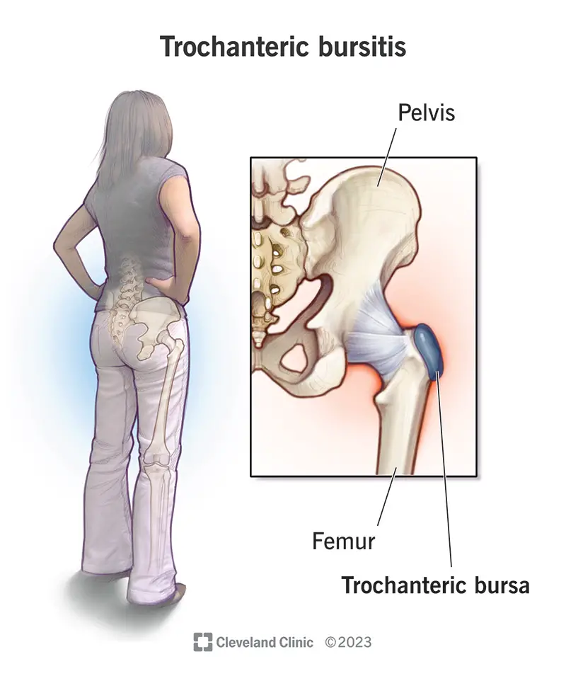 4964 trochanteric bursitis