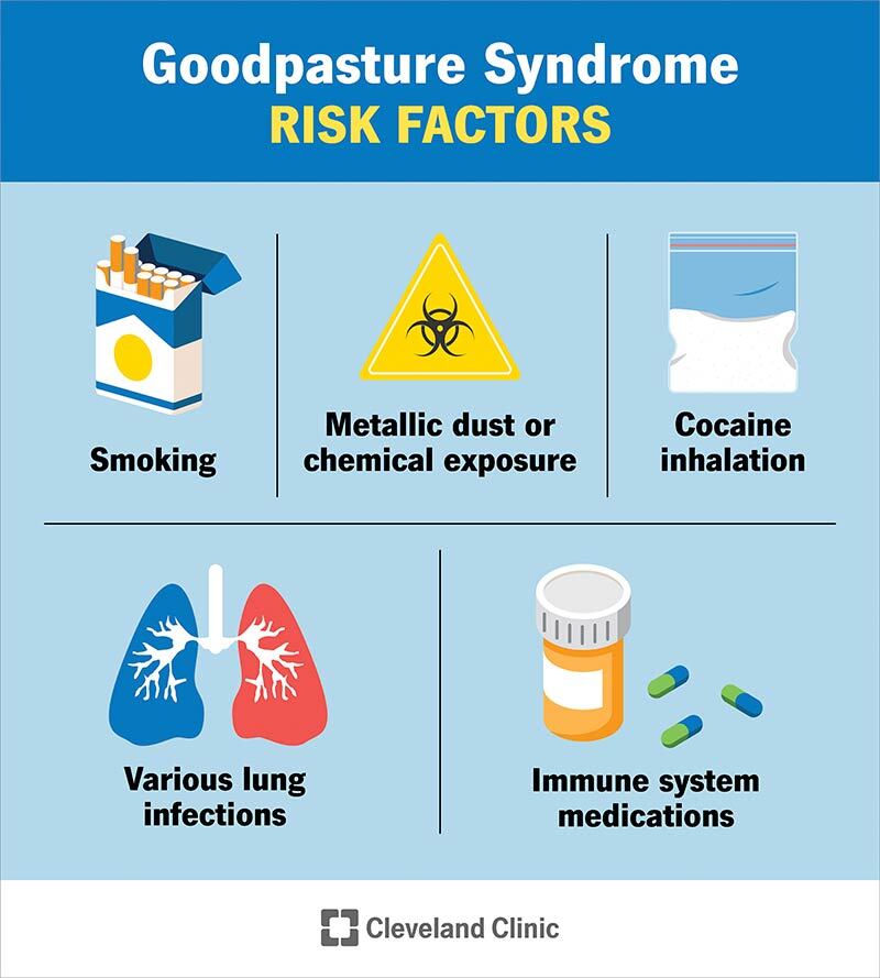 5927 goodpasture syndrome