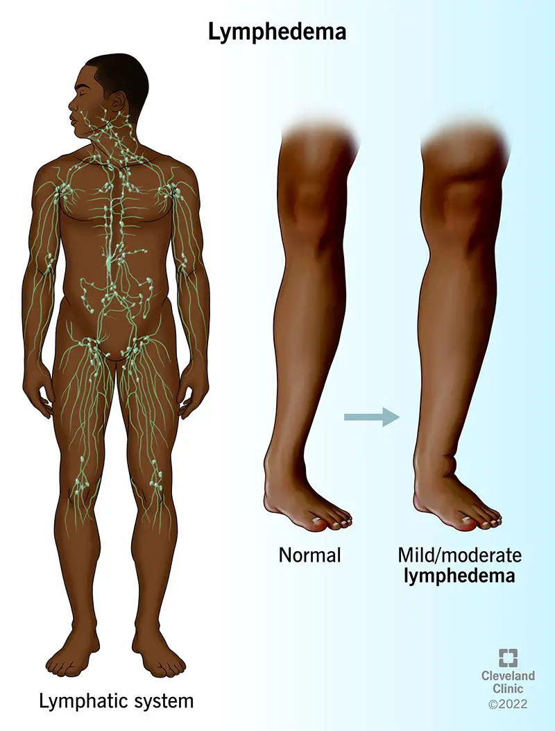 Blauzda be limfedemos (centre) ir blauzda su lengva / vidutinio sunkumo limfedema (dešinėje).