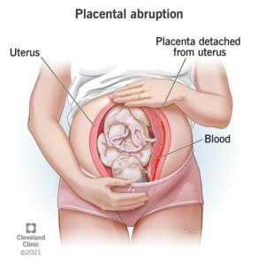 9435 placental abruption