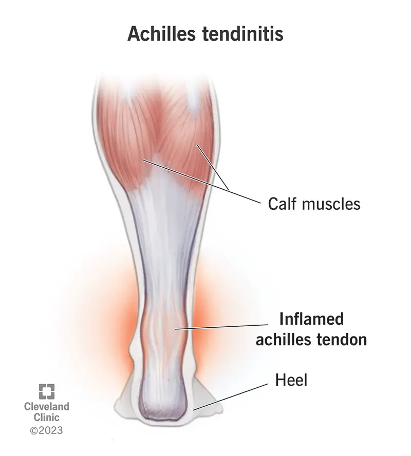 achilles tendinitis