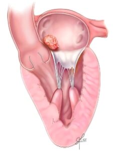 cardiac tumors atrial myxoma sm.ashx