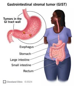 gastrointestinal stromal tumor