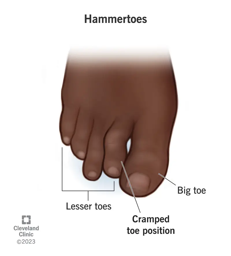 hammertoes