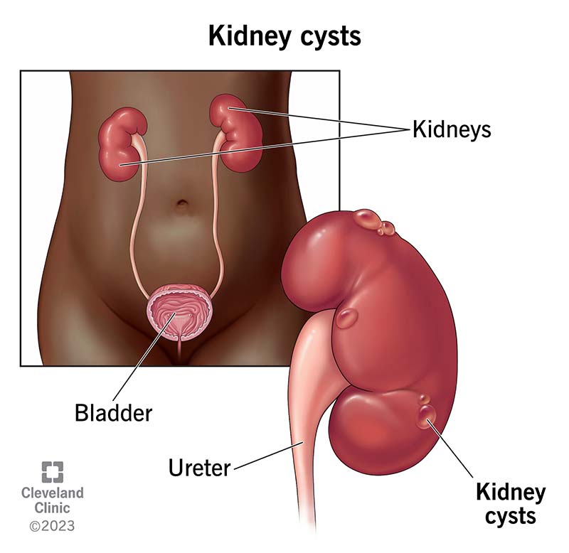 kidney cysts