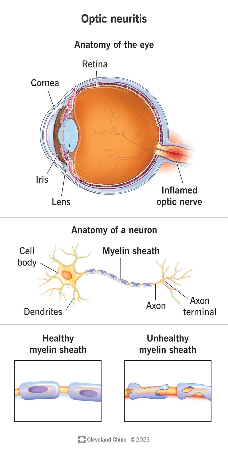 Optinis neuritas, akies anatomija, neurono anatomija, sveikas ir nesveikas mielino apvalkalas