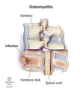 osteomyelitis