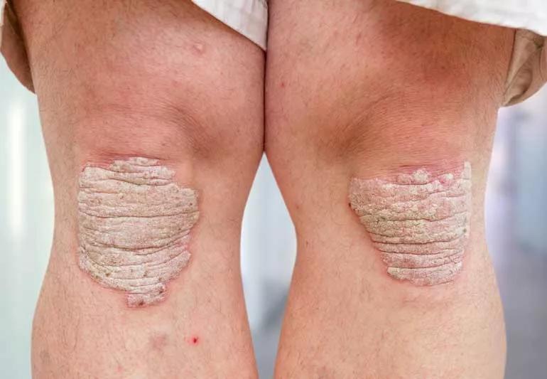 psoriasisArthKneesGrey 168494775