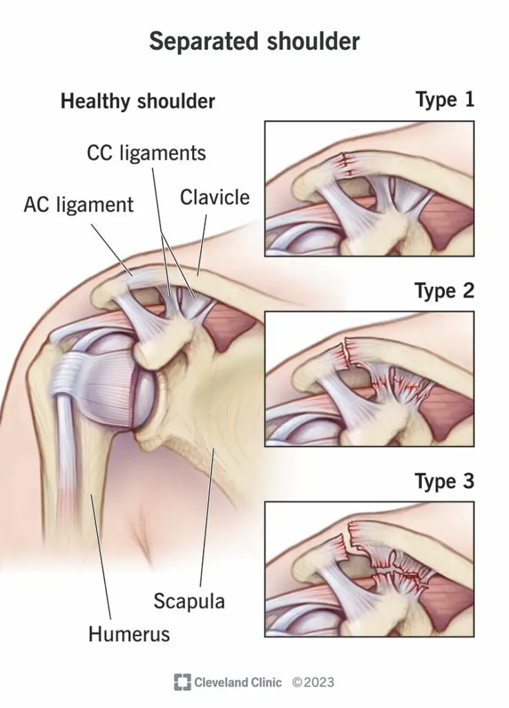 separated shoulder