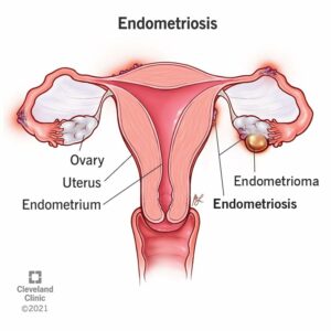 10857 endometriosis