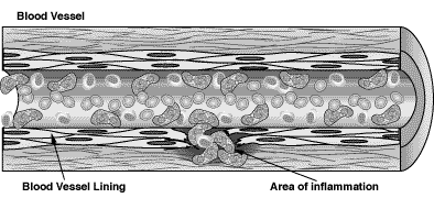 Mikroskopinio poliangito iliustracija