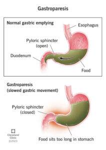 15522 gastroparesis feature