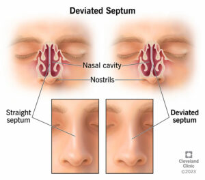 16924 deviated septum