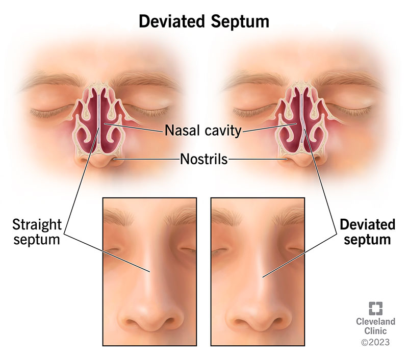 16924 deviated septum