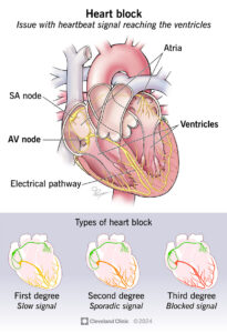 17056 heart block