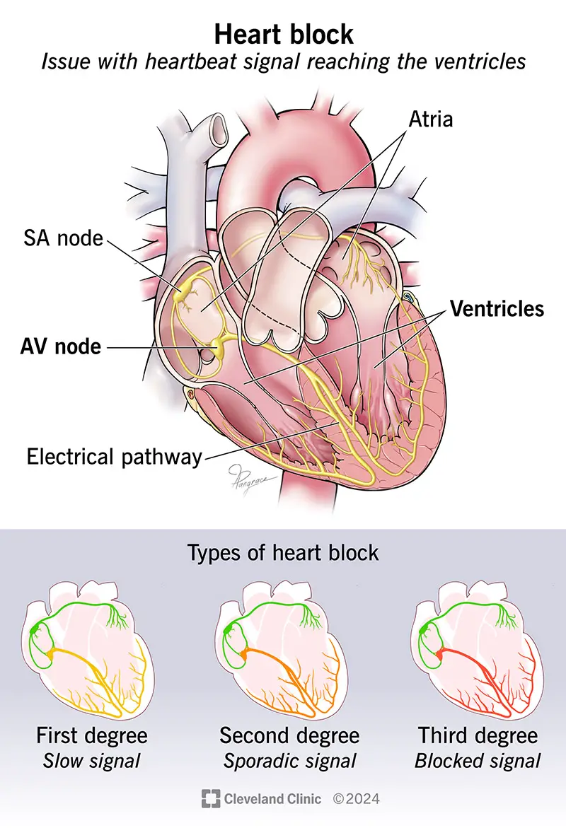 Esant širdies blokadai, širdies plakimo signalai, skirti jūsų skilveliams, gali būti lėti, nepatikimi arba visiškai užblokuoti.