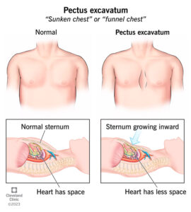 17328 pectus excavatum