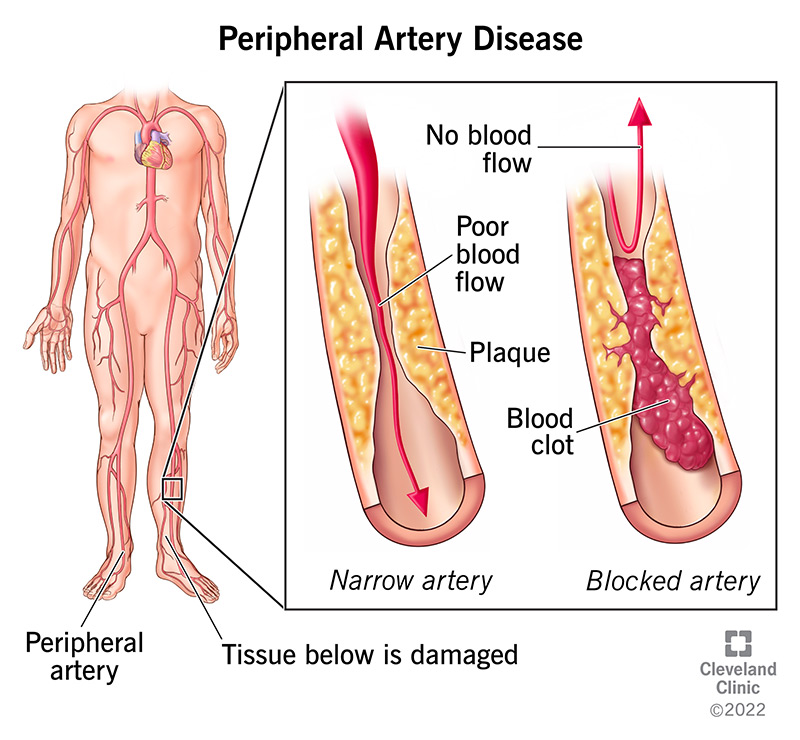 17357 peripheral arterial disease illustration 2