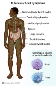 17940 cutaneous t cell lymphoma