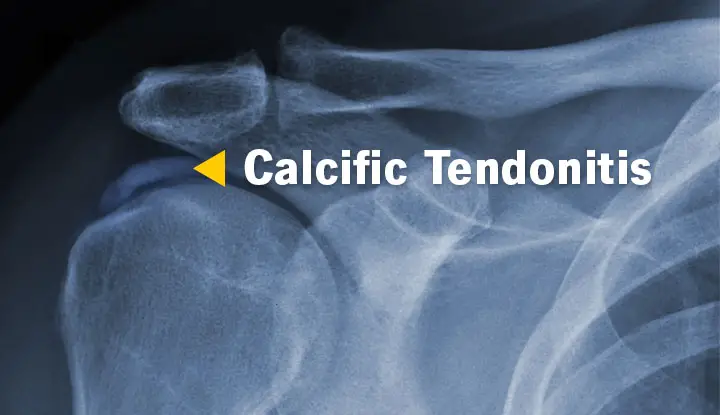 21638 Calcific Tendonitis