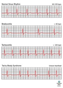 21789 sick sinus syndrome illustration.ashx