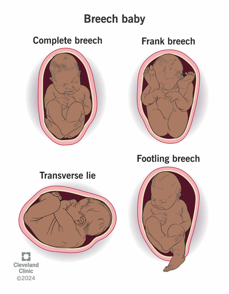 21848 breech baby