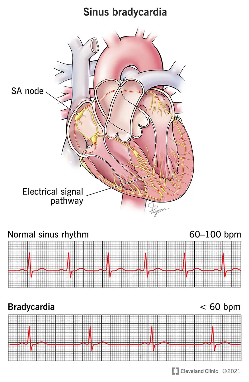 EKG ir sinusinės bradikardijos iliustracija.