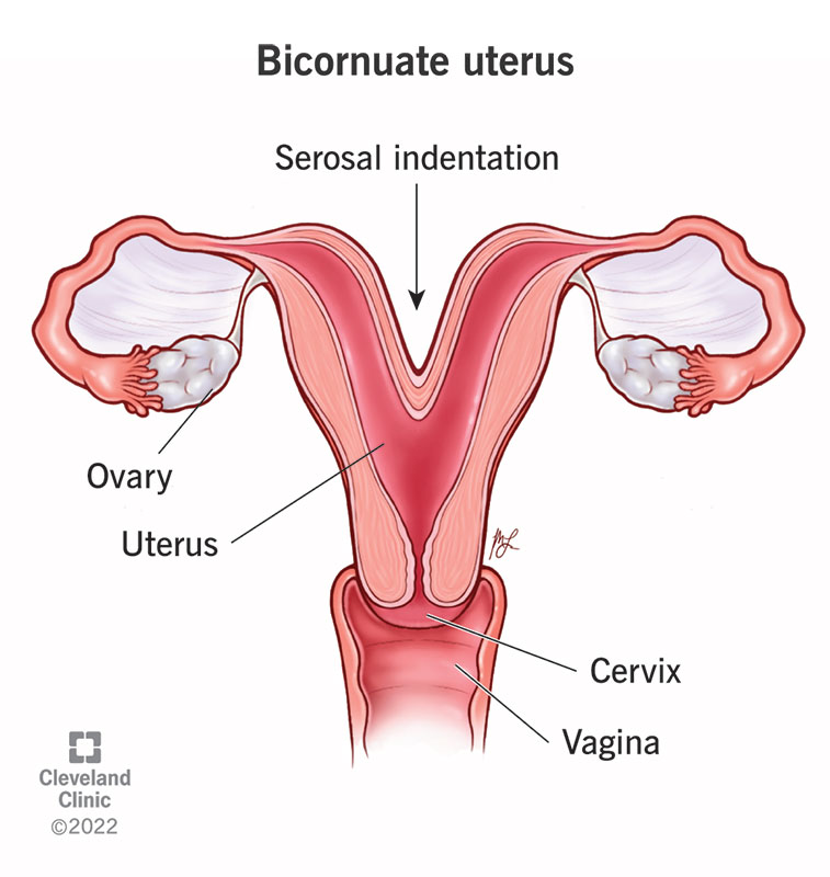 22798 bicornuate uterus