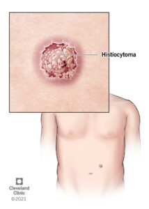 23059 histiocytoma