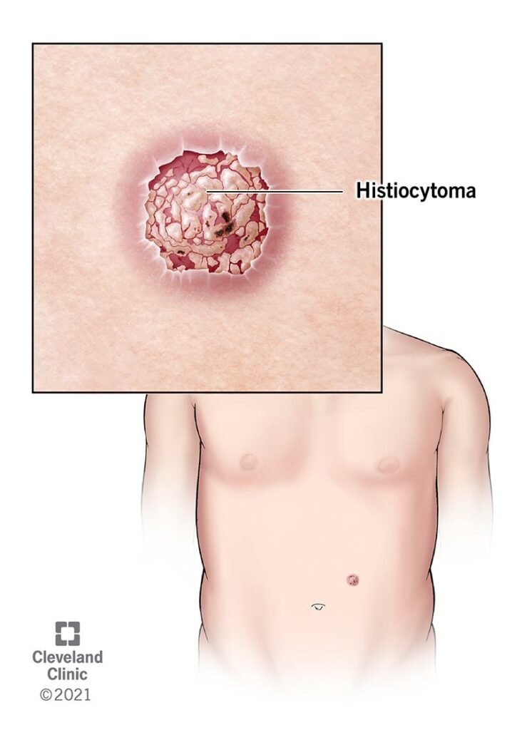 23059 histiocytoma